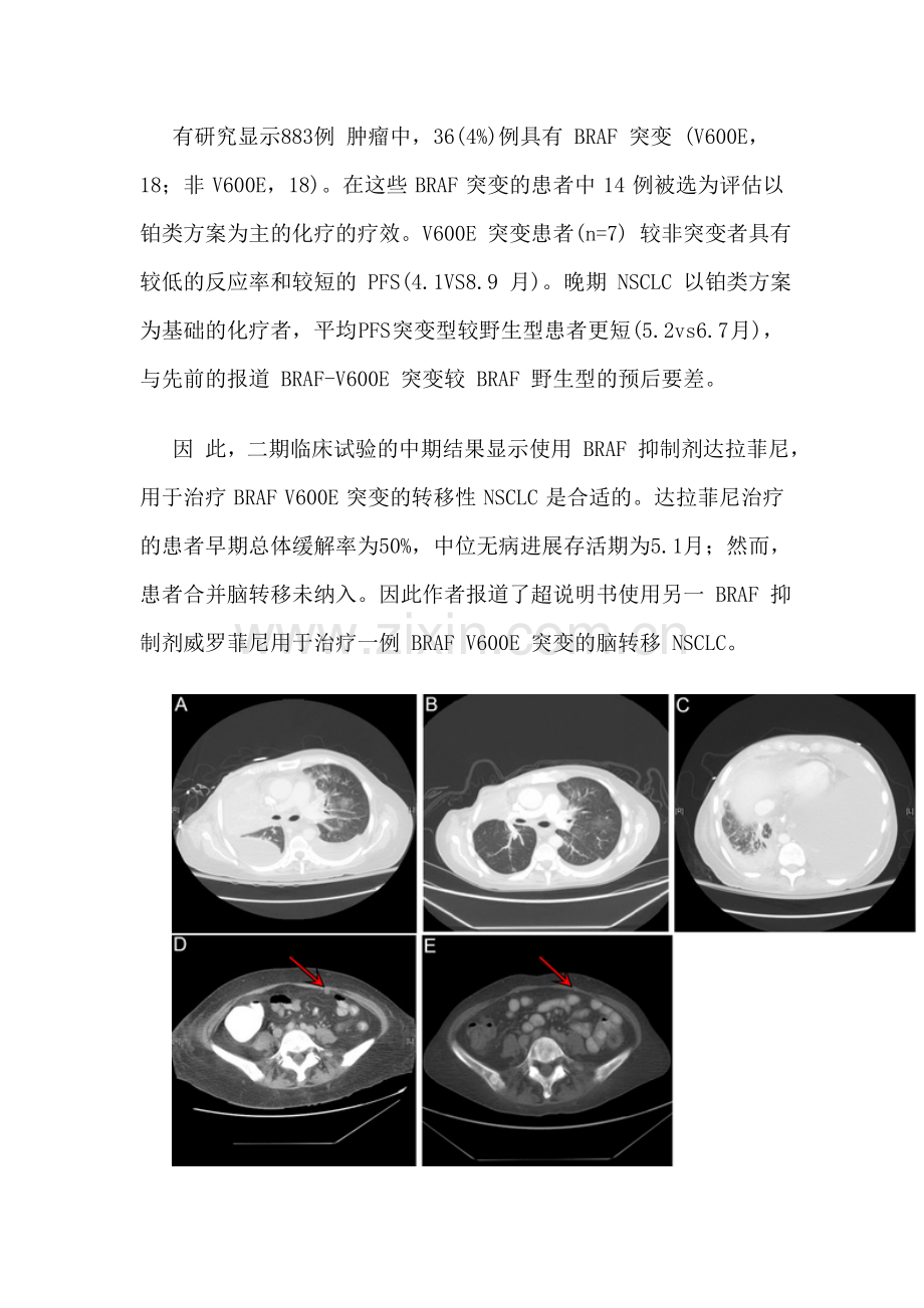 威罗菲尼可治疗肺腺癌脑转移.doc_第2页