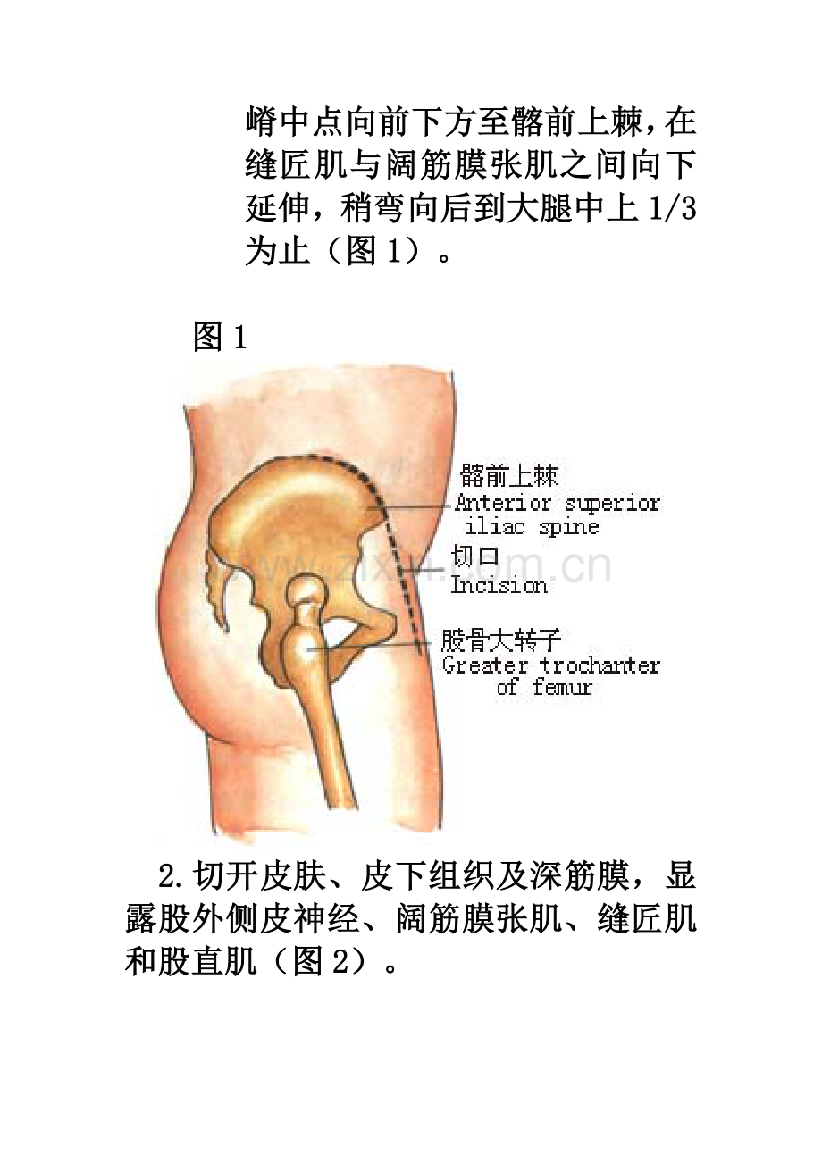 先天性髋关节脱位的手术.doc_第2页