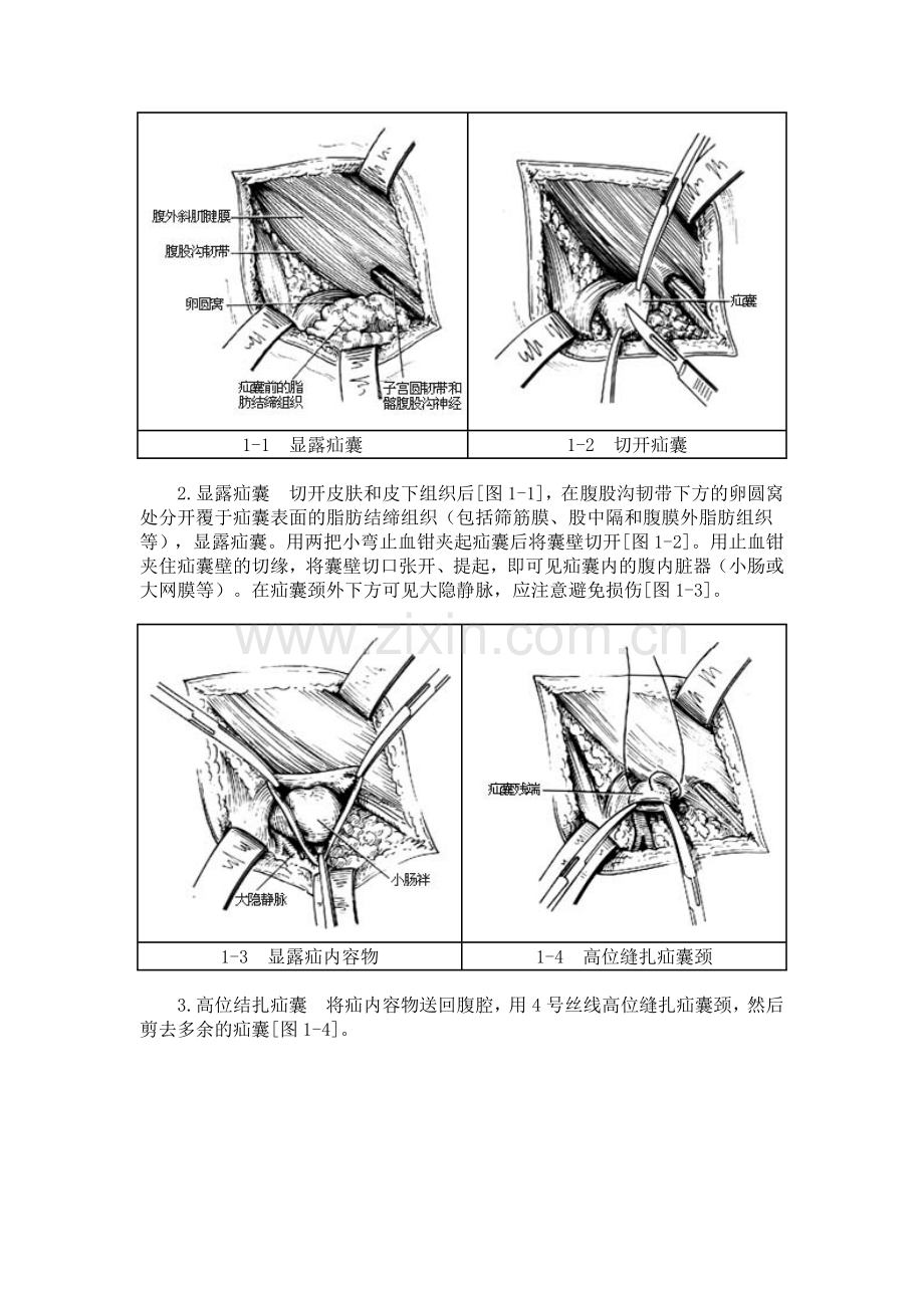 股疝修复术图谱.doc_第2页