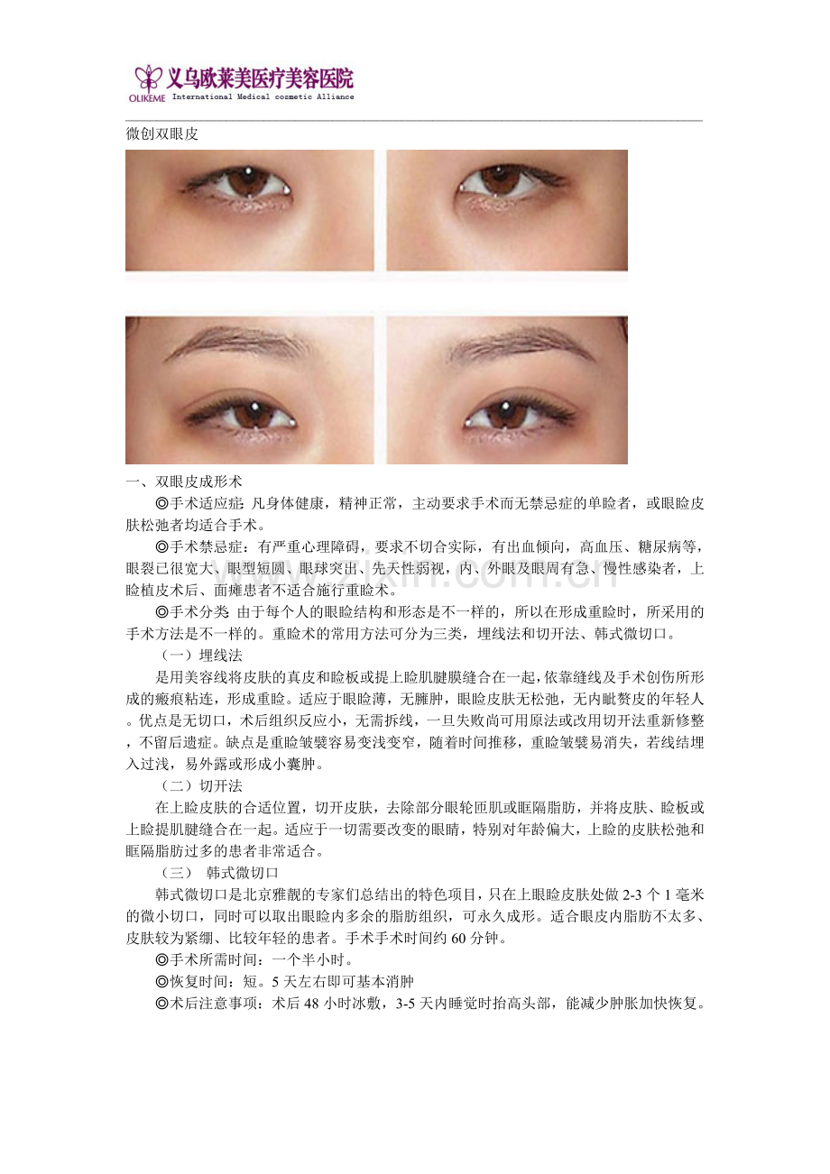 微创双眼皮手术介绍.doc_第1页