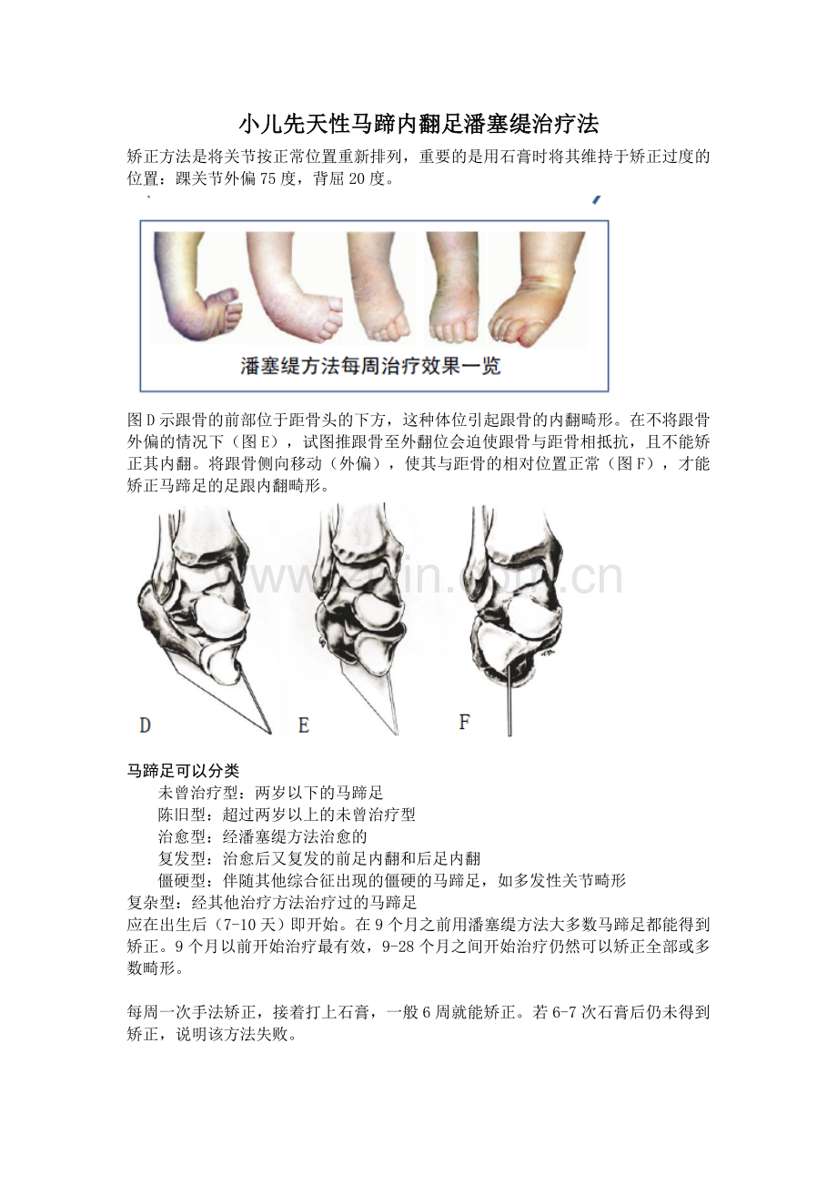 小儿先天性马蹄内翻足潘塞缇治疗法.doc_第1页