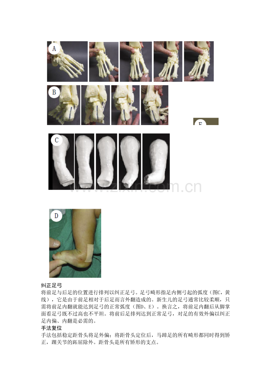 小儿先天性马蹄内翻足潘塞缇治疗法.doc_第2页