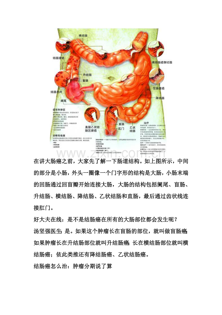 早期结肠癌治愈率可达95%.doc_第2页