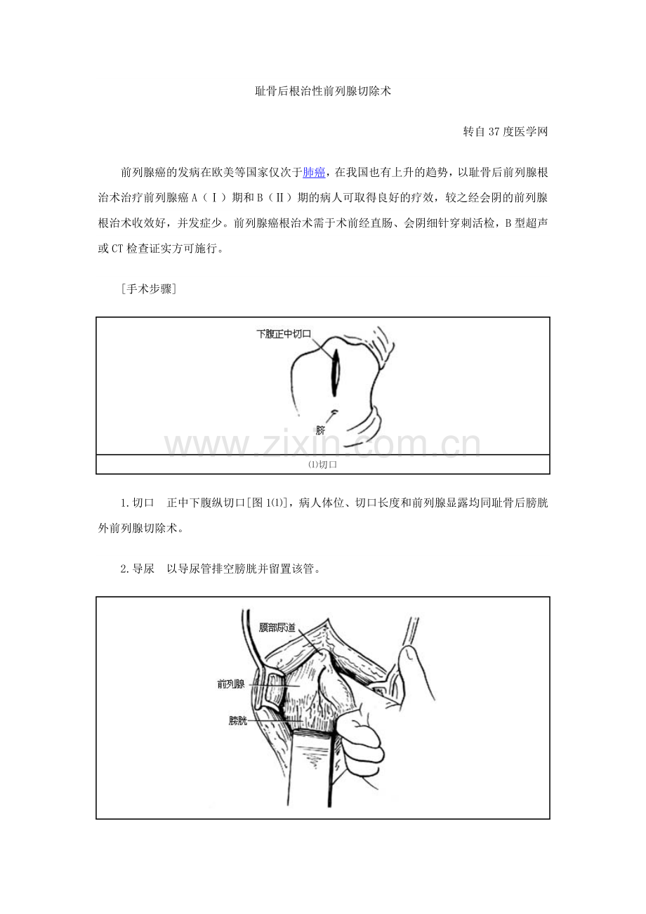 耻骨后根治性前列腺切除术.doc_第1页