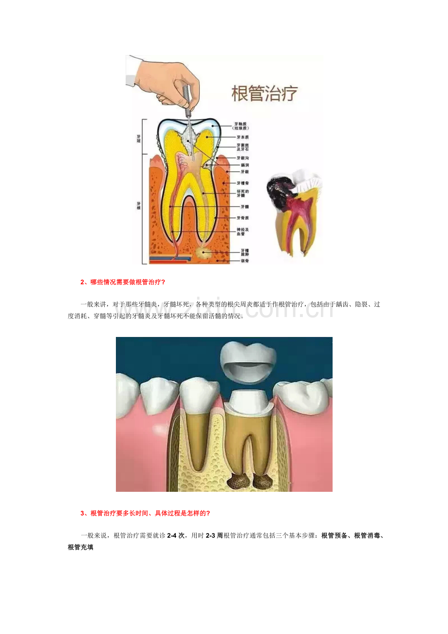 根管治疗是不是就是我们常说的抽牙神经？.docx_第2页