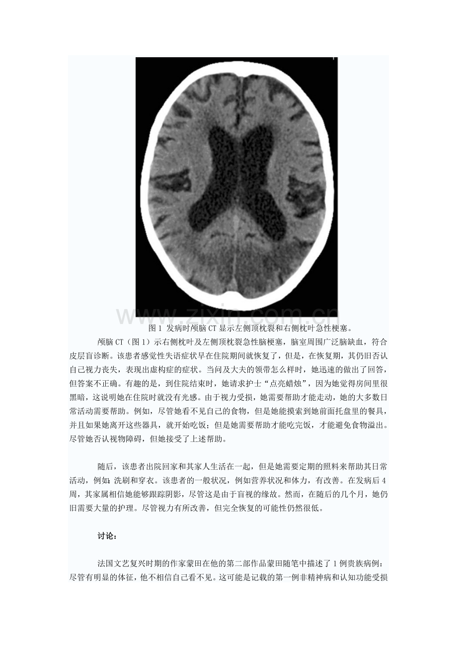 Anton’s综合征病例报道.doc_第2页