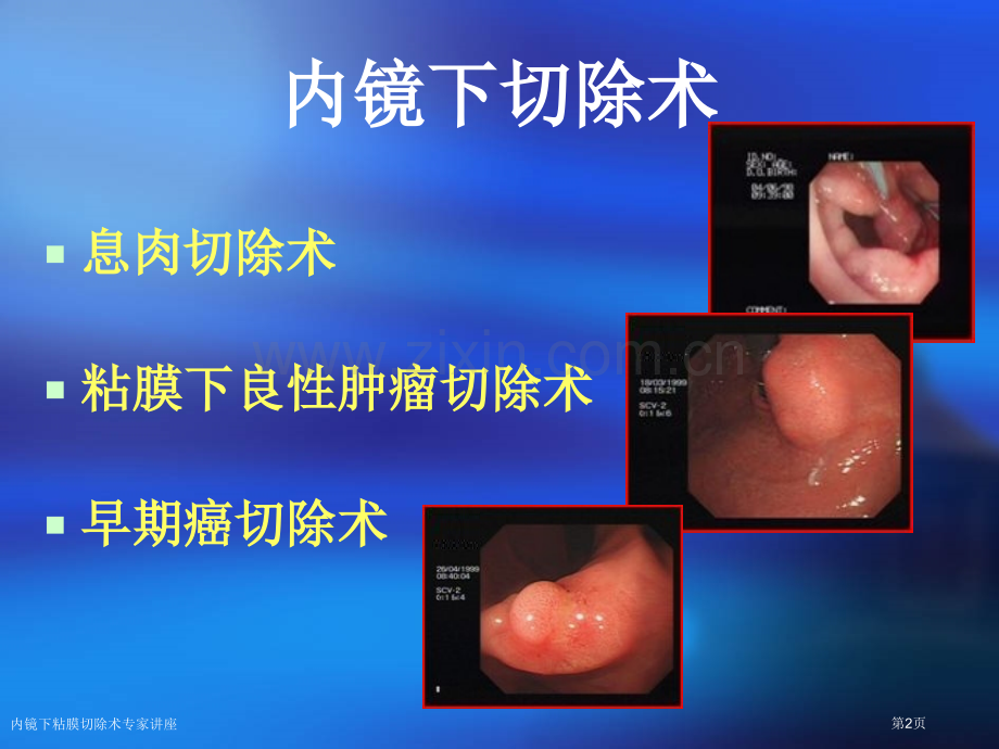 内镜下粘膜切除术专家讲座.pptx_第2页