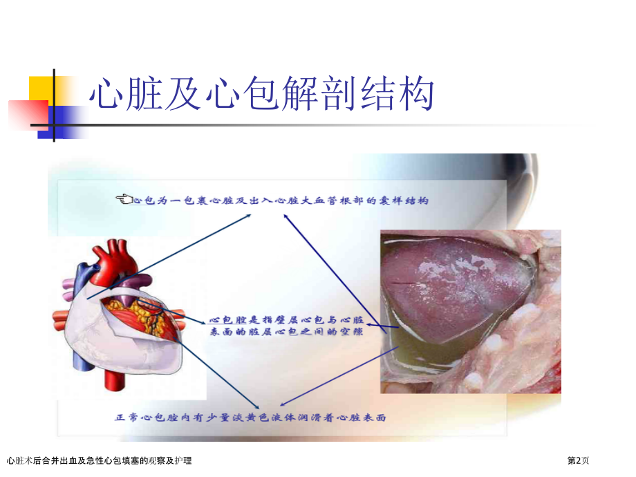 心脏术后合并出血及急性心包填塞的观察及护理.pptx_第2页