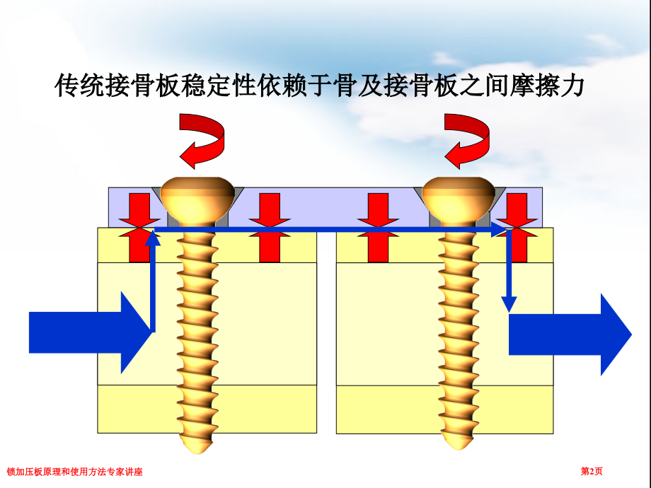 锁加压板原理和使用方法专家讲座.pptx_第2页