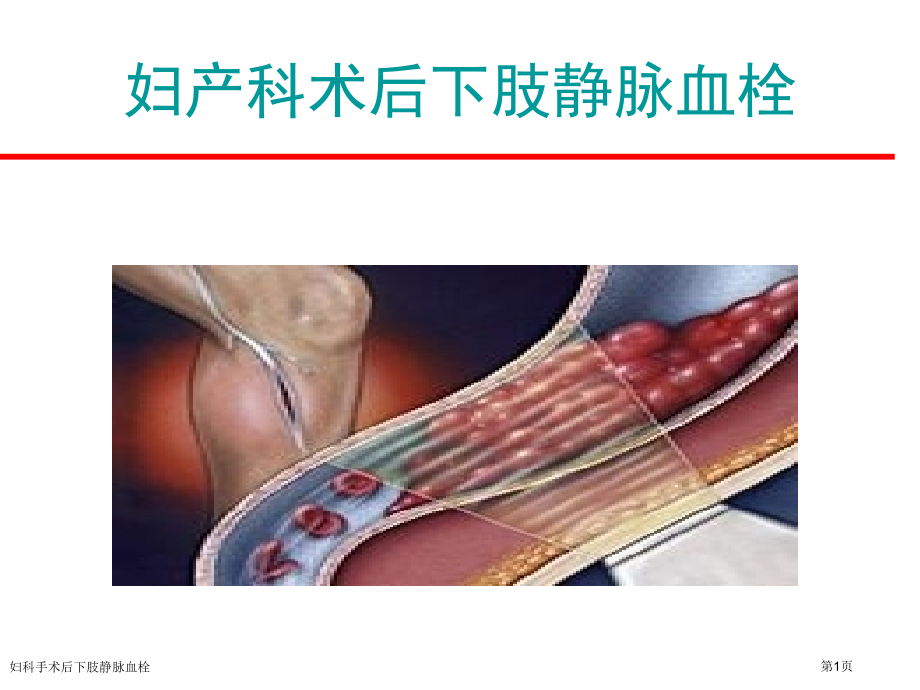 妇科手术后下肢静脉血栓.pptx_第1页