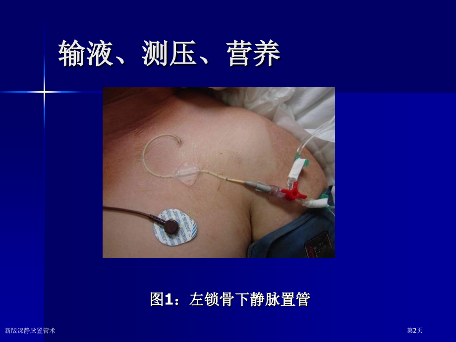 新版深静脉置管术.pptx_第2页