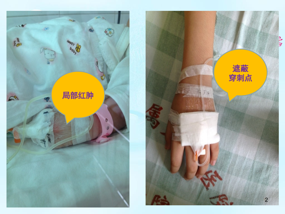 静脉留置针临床操作规范标准(课堂PPT).ppt_第2页
