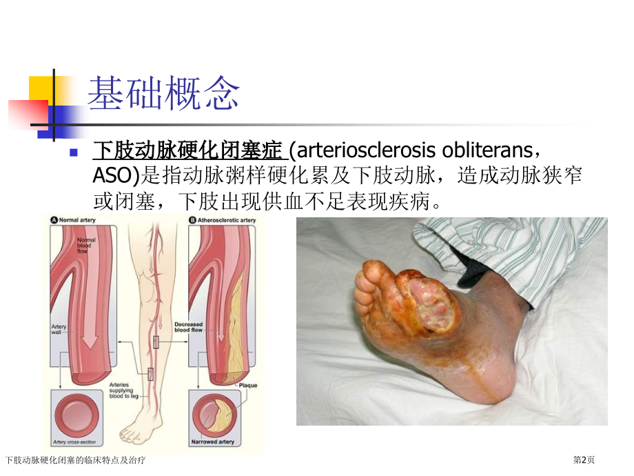 下肢动脉硬化闭塞的临床特点及治疗.pptx_第2页