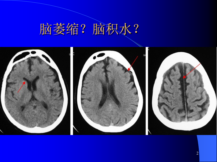 脑积水与脑萎缩的CT和MRI诊断课件.ppt_第2页