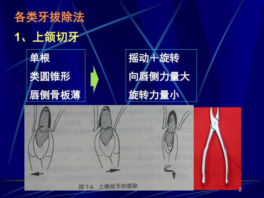 一般牙及残根拔除术(课堂PPT).ppt_第2页