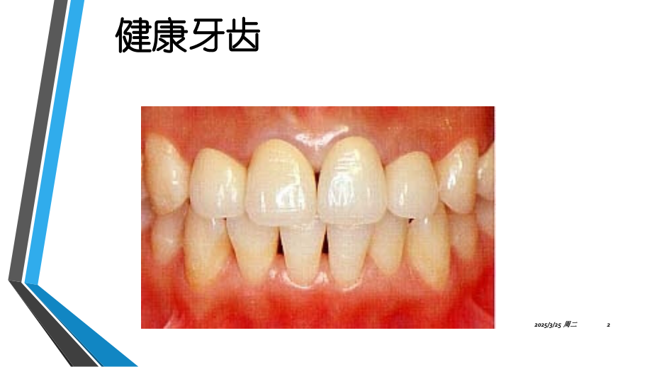 龋齿的治疗方法PPT学习课件.ppt_第2页