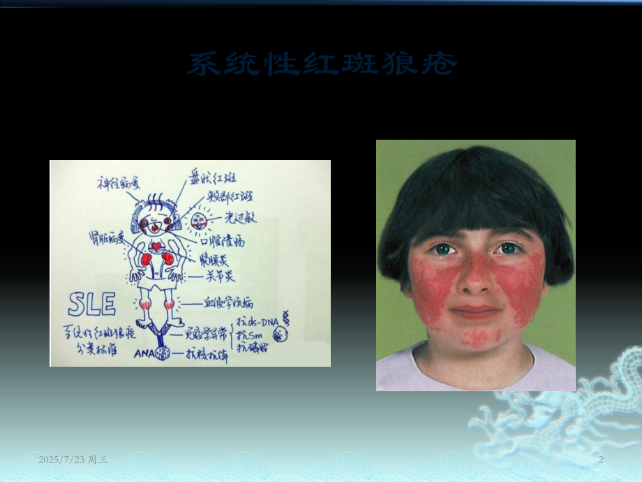 系统性红斑狼疮相关血小板减少PPT.ppt_第2页