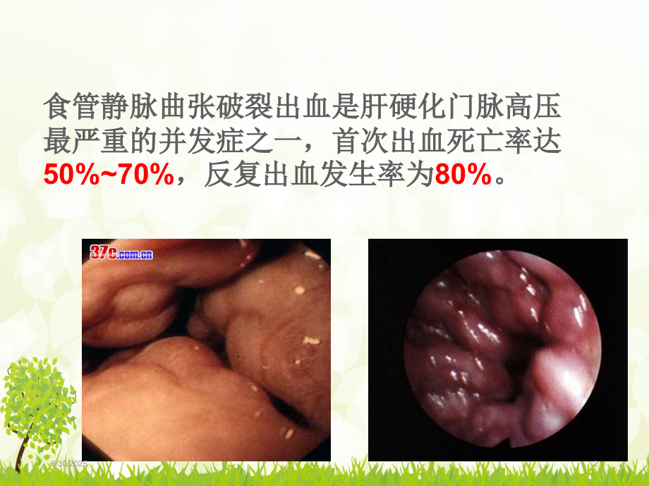 食管静脉曲张套扎术幻灯片.ppt_第2页