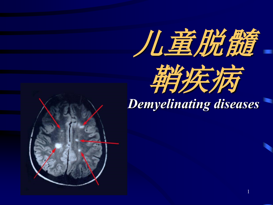 儿童脱髓鞘疾病(课堂PPT).ppt_第1页