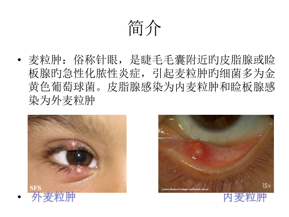 医学麦粒肿手术专题知识宣教课件.pptx_第2页