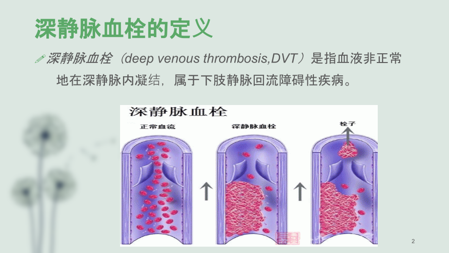 深静脉血栓评估课件.ppt_第2页