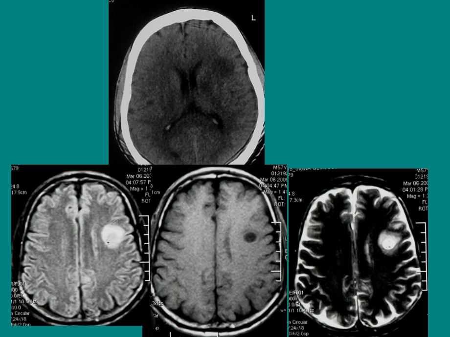 肿瘤样脱髓鞘病变影像特征以及鉴别诊断ppt课件.ppt_第2页