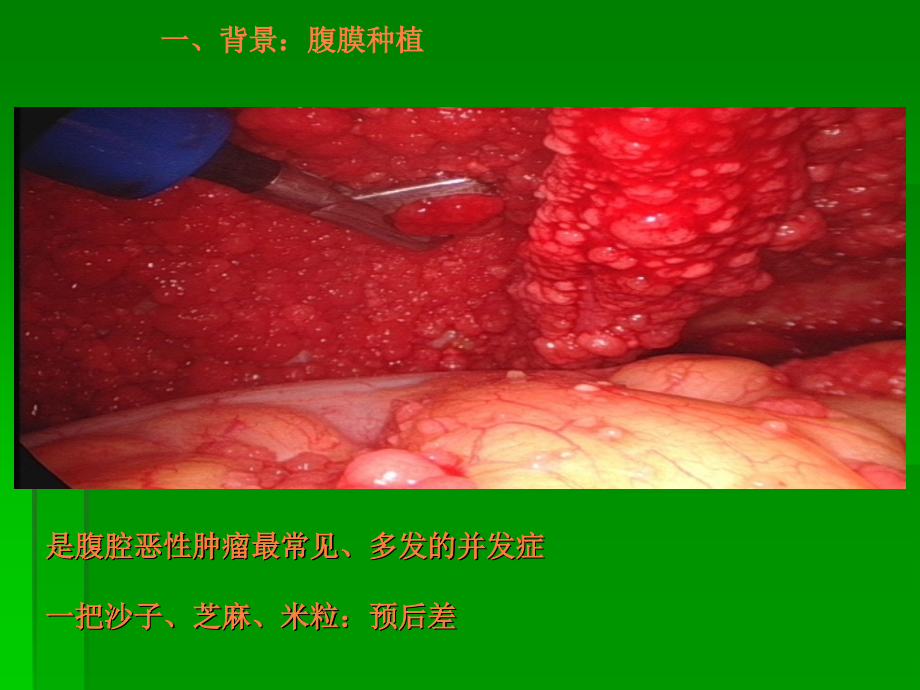 腹腔、膀胱热灌注化疗的临床应用及其新进展ppt课件.ppt_第2页