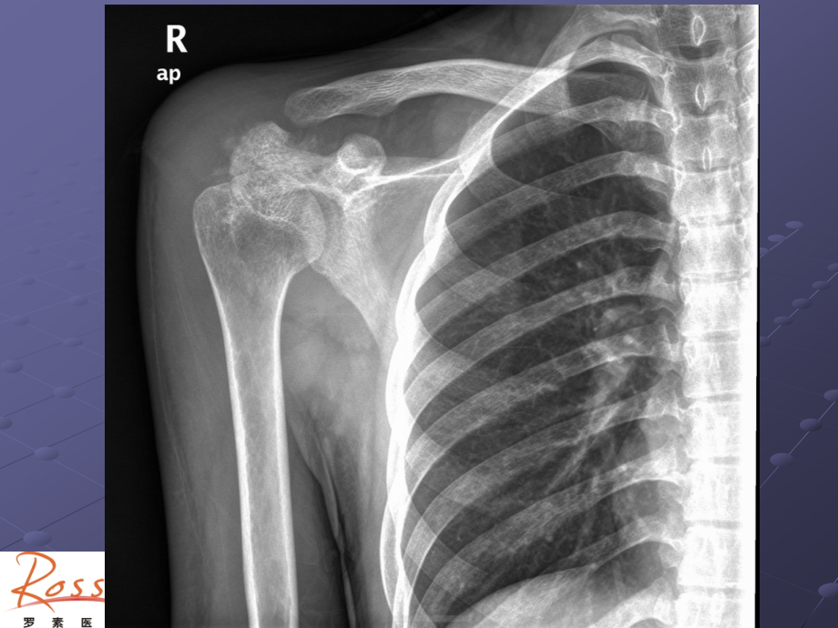 尤文氏肉瘤课件ppt课件.ppt_第2页