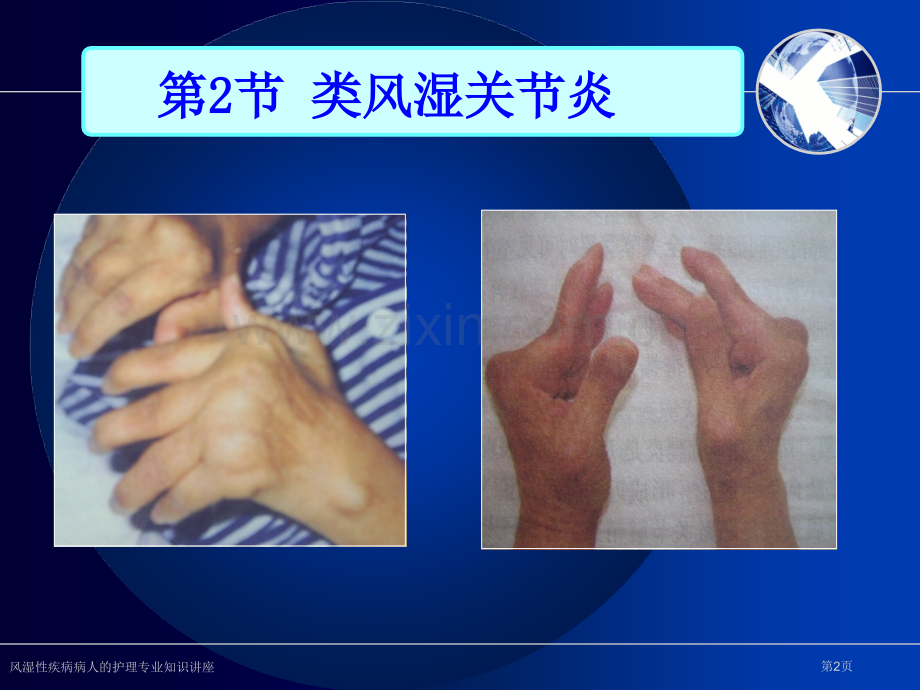 风湿性疾病病人的护理专业知识讲座.pptx_第2页