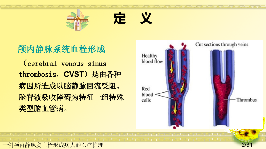 一例颅内静脉窦血栓形成病人的医疗护理.ppt_第2页