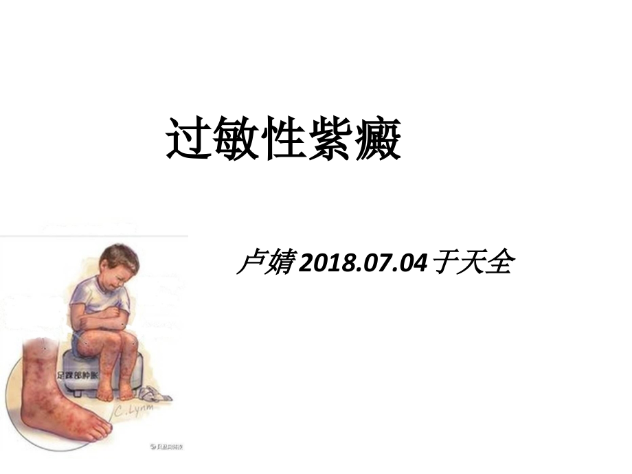 过敏性紫癜.pptx_第1页
