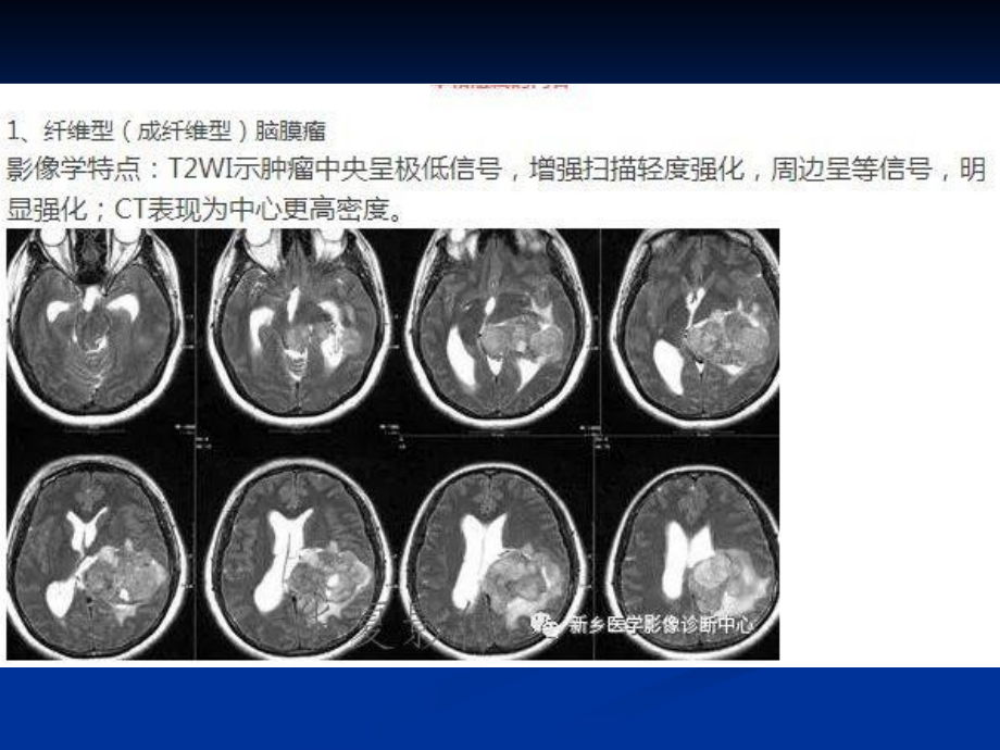 种脑膜瘤.pptx_第2页