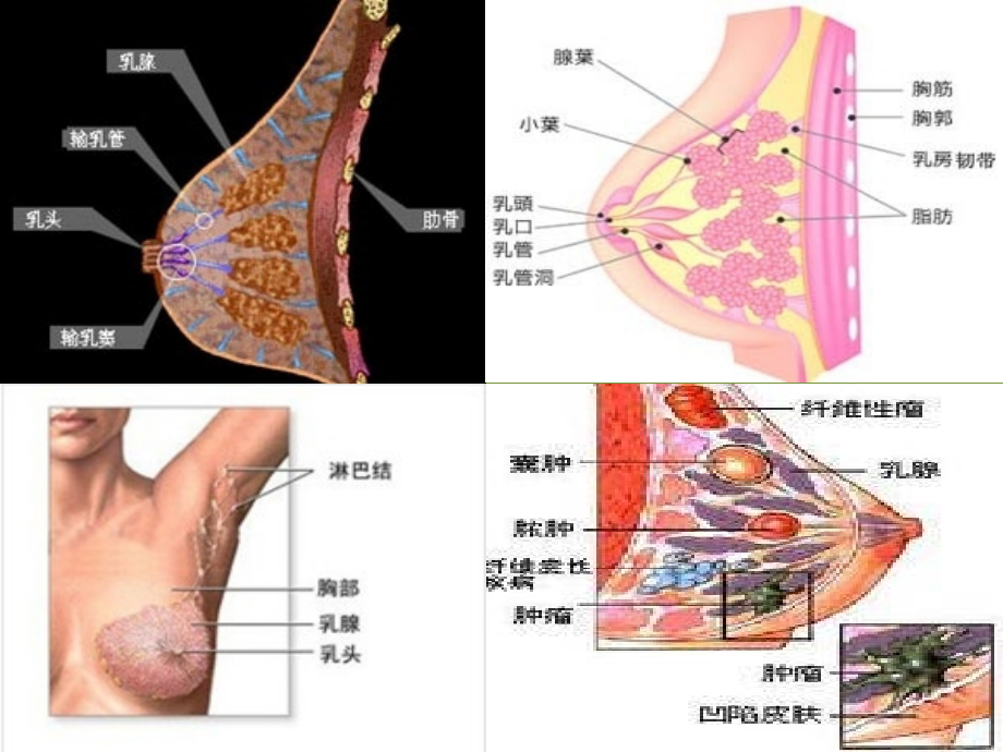 浆液性乳腺炎.pptx_第2页