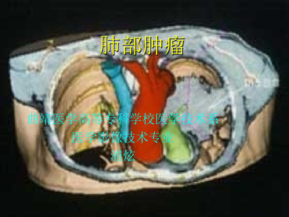 影像系肺部肿瘤.pptx_第1页
