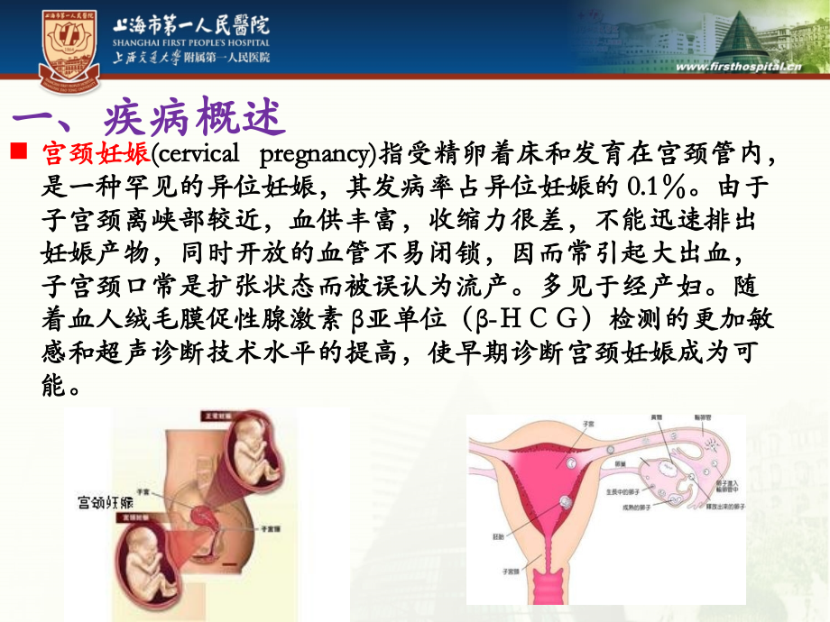 宫颈妊娠业务学习.pptx_第1页