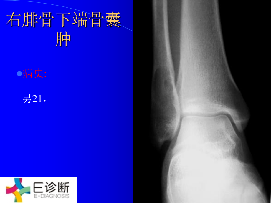 医学影像-骨肿瘤X线病例图谱(详细).ppt_第1页