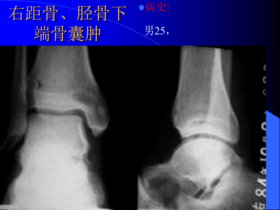 医学影像-骨肿瘤X线病例图谱(详细).ppt_第2页