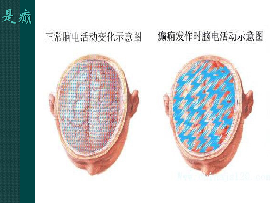 神经科护理查房--癫痫.ppt_第2页
