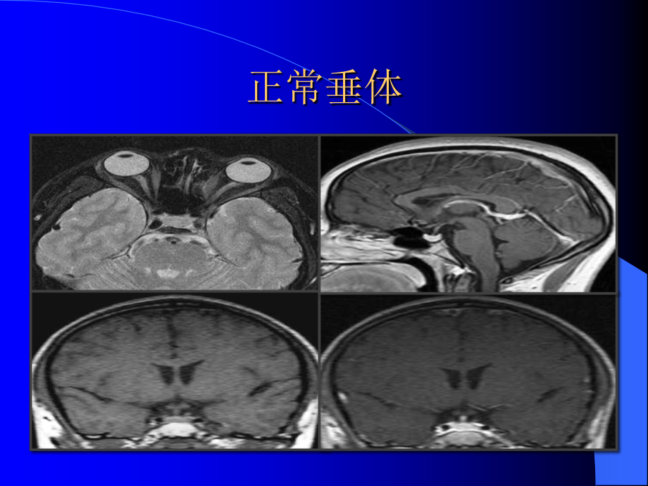 垂体瘤-(2)ppt课件.ppt_第2页