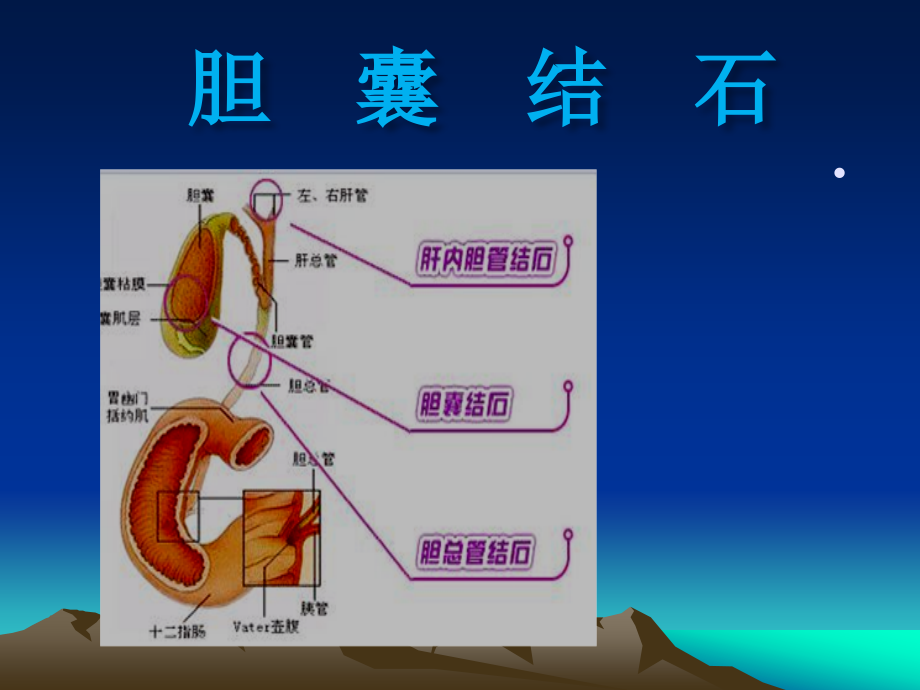 胆囊结石护理PPT.ppt_第1页