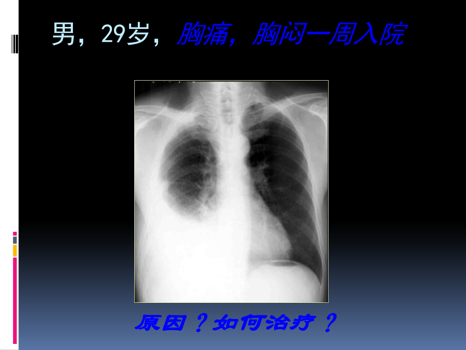 胸腔积液课件.ppt_第1页