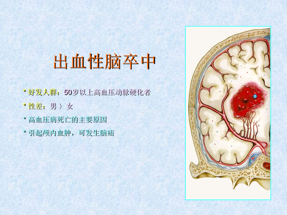 脑卒中的外科治疗.ppt_第2页
