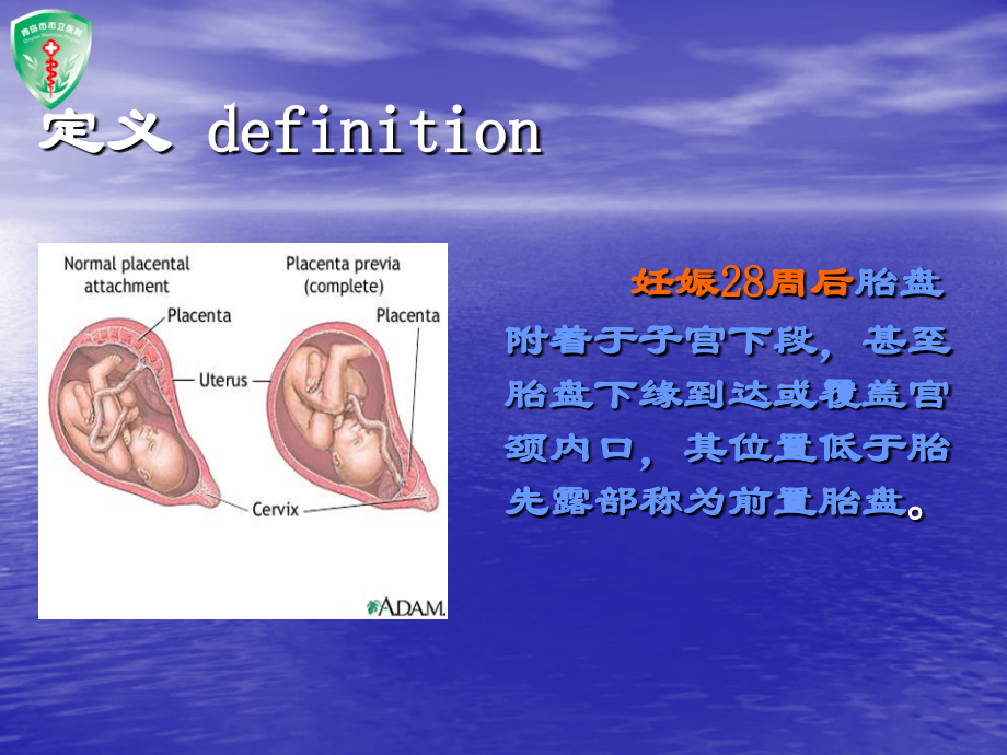 前置胎盘专题培训.pptx_第2页