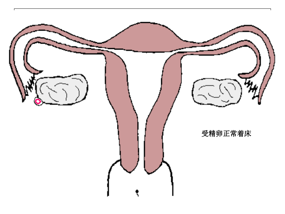 宫角部间质部妊娠鉴别讲解学习.ppt_第2页