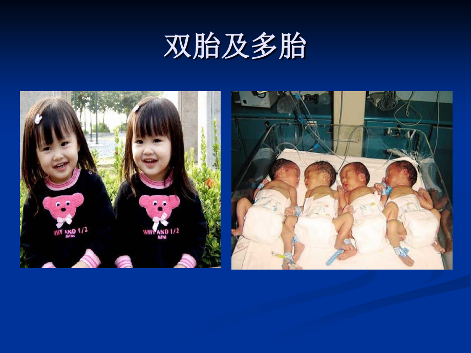 双胎及多胎妊娠的产前诊断教学文稿.ppt_第2页