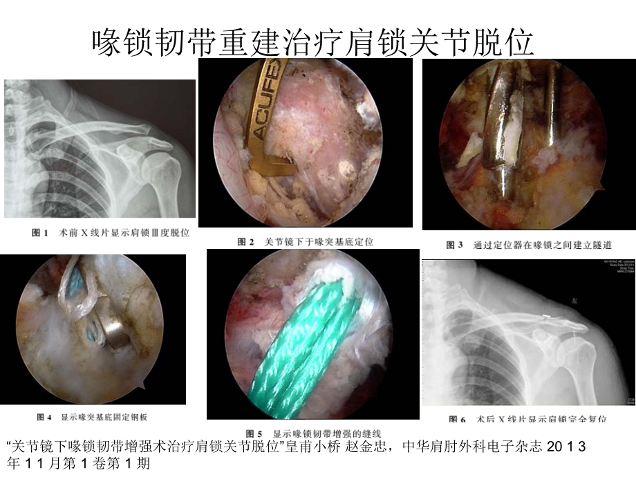 肩关节镜临床应用解析讲解学习.ppt_第2页