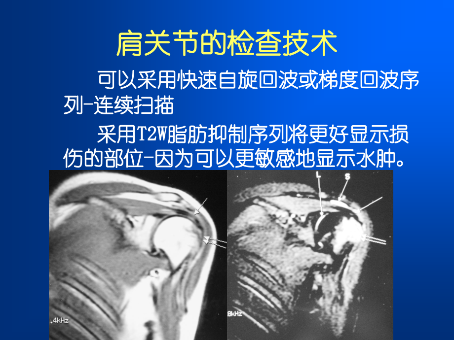 肩袖损伤MRI诊断教学提纲.ppt_第2页