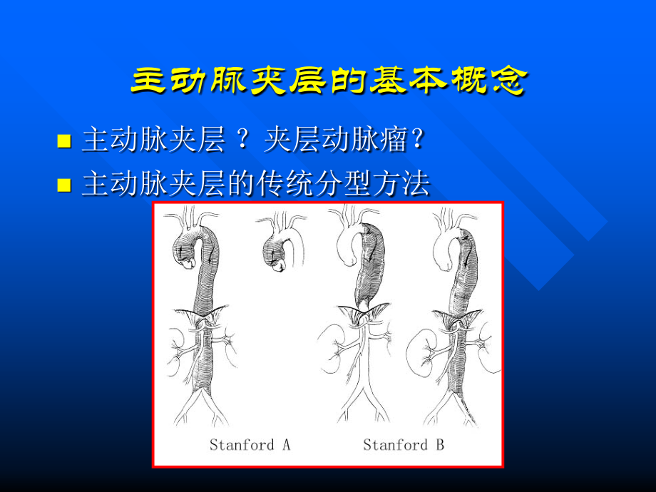 主动脉夹层分型及治疗教学教材.ppt_第2页