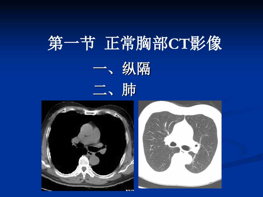 胸部常见疾病CT诊断与鉴别诊断电子教案.ppt_第2页