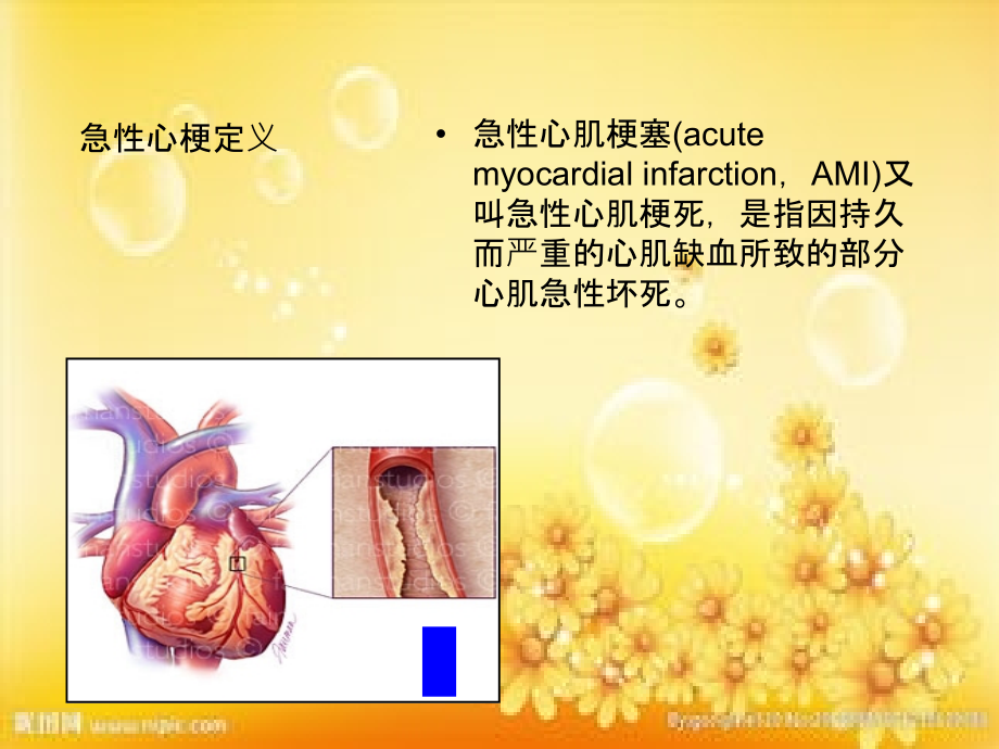 急性心梗急诊行PCI术中配合.ppt_第2页